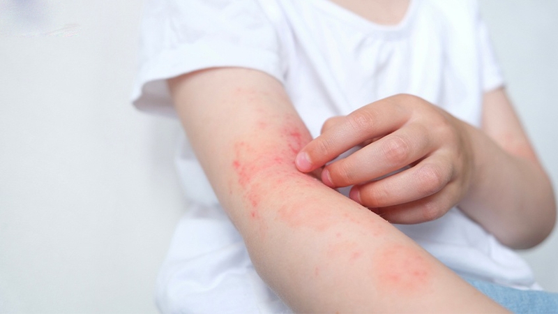 Các loại dị ứng​ thường gặp và cách phòng ngừa hiệu quả 1