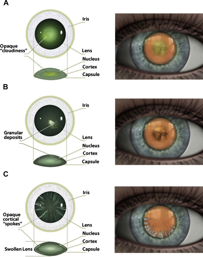 Thủy tinh thể bị đục khiến ảnh vật không hiện trên võng mạc 2