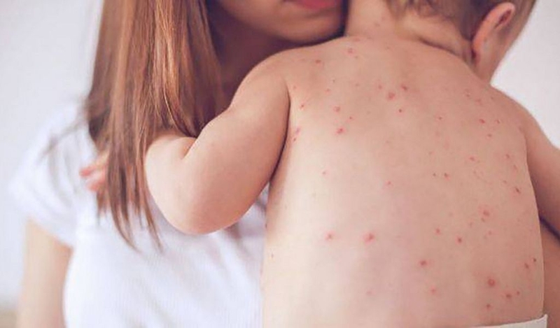 Các loại mụn ở trẻ sơ sinh? Loại kem trị viêm da nào phù hợp cho bé? 2