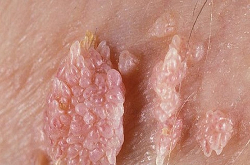 Các loại mụn ở vùng kín phổ biến và những nguyên nhân gây ra các loại mụn ở vùng kín 2