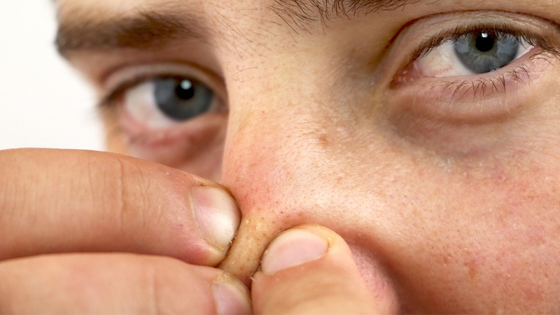 cac-loai-mun-trung-ca-thuong-gap-va-cach-phong-ngua-mun-trung-ca 2.jpg