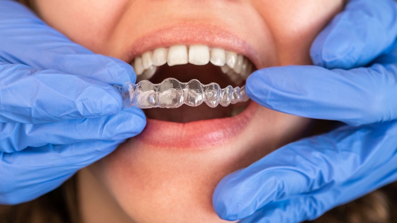 Các loại niềng răng trong suốt hiện nay: So sánh cụ thể từng loại! 4