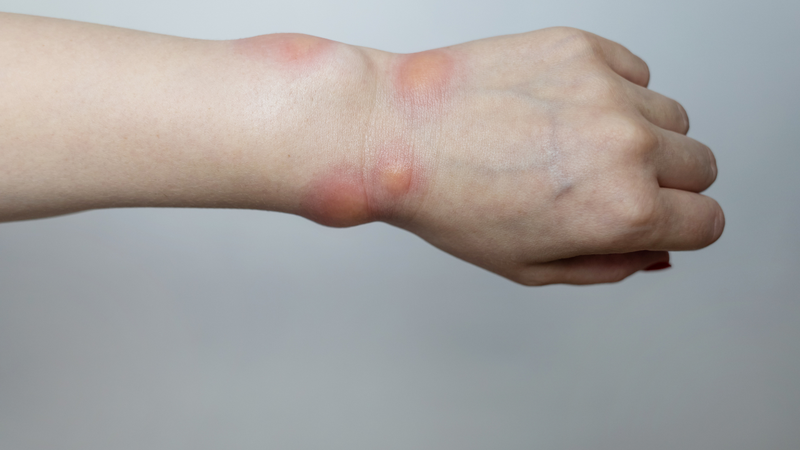 Bị ong đốt gây đau nhức tại chỗ