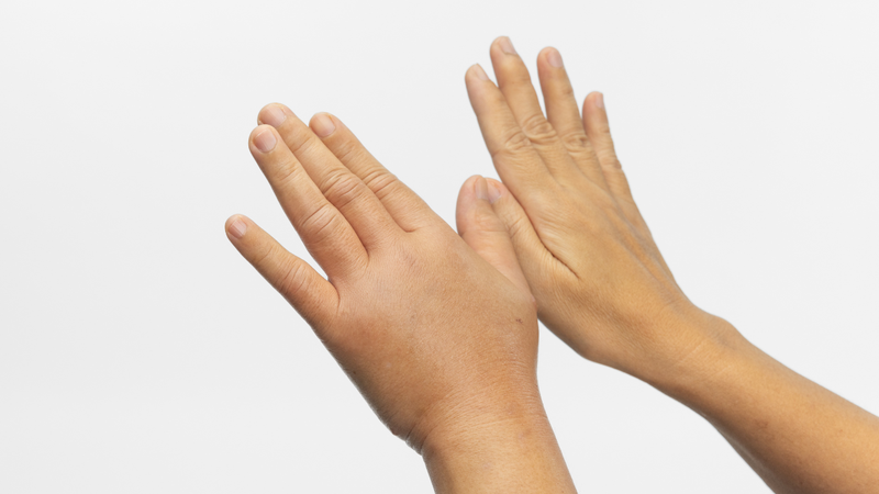 Ong đốt thường chỉ gây đau nhức, sưng tấy và đỏ tại chỗ