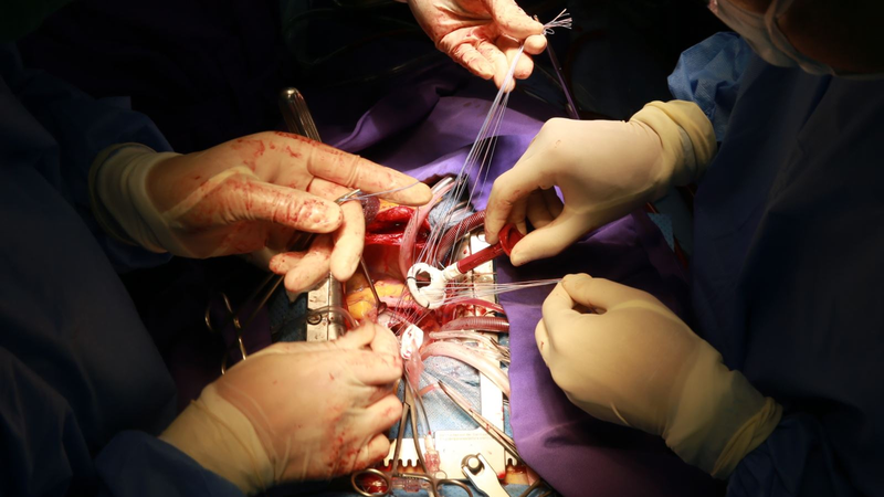 Các loại phẫu thuật tim hay gặp ở bệnh lý tim mạch