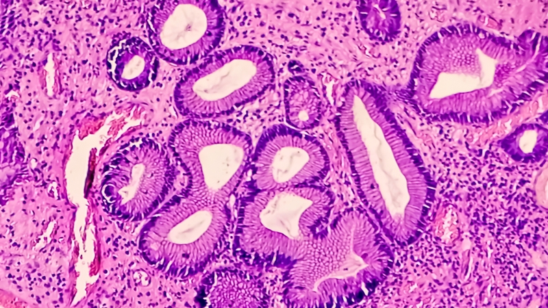 Các loại polyp dạ dày: Dấu hiệu nhận biết và mức độ nguy hiểm 2