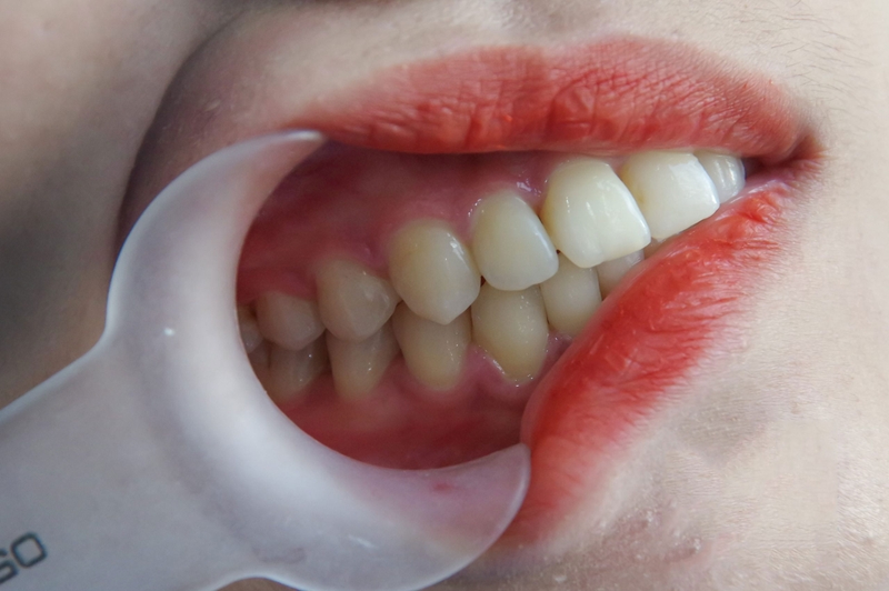 Các loại răng vẩu thường gặp và cách khắc phục 1