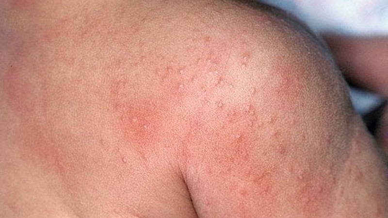 Các loại sữa tắm trị rôm sảy cho bé mẹ nên biết1