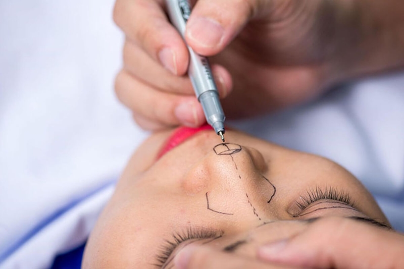 Các loại sụn nâng mũi​ phổ biến hiện nay bạn nên biết 2