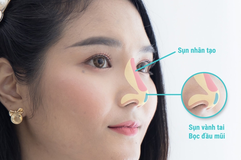 Các loại sụn nâng mũi​ phổ biến hiện nay bạn nên biết 1