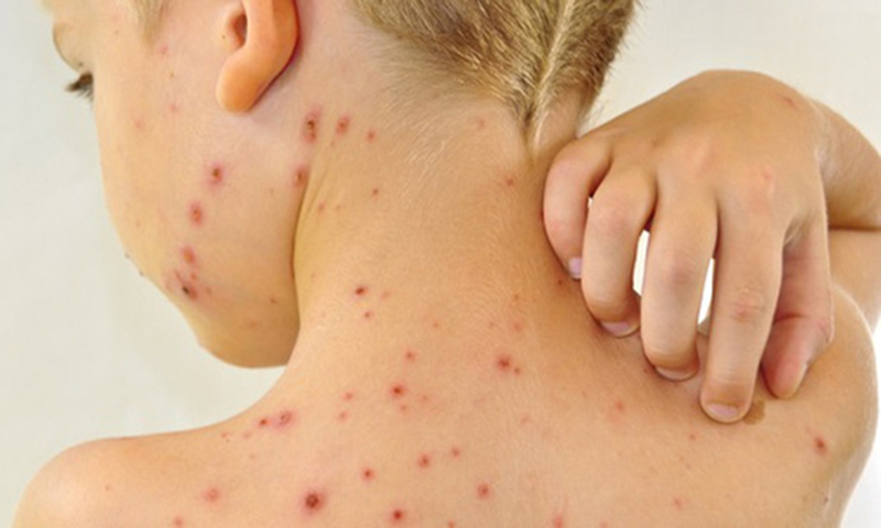 Các loại thuốc bôi thuỷ đậu nên dùng và cách sử dụng 1