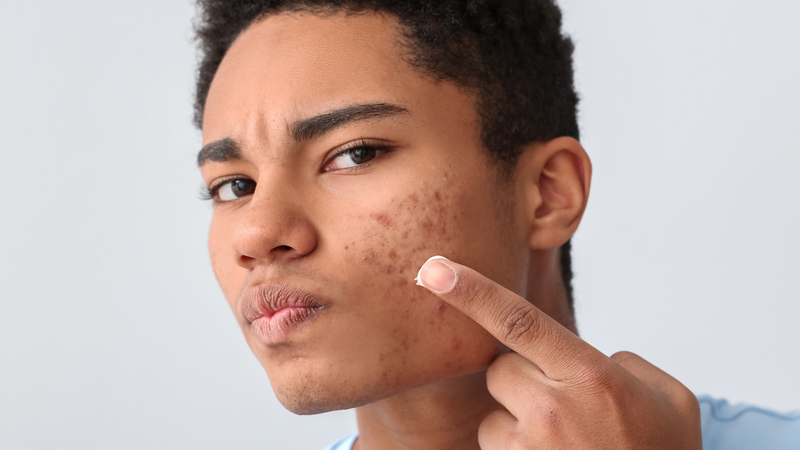 Thuốc trị mụn ảnh hưởng đến nội tiết tố