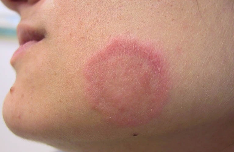 Các loại thuốc trị Hắc Lào ở mặt hiệu quả