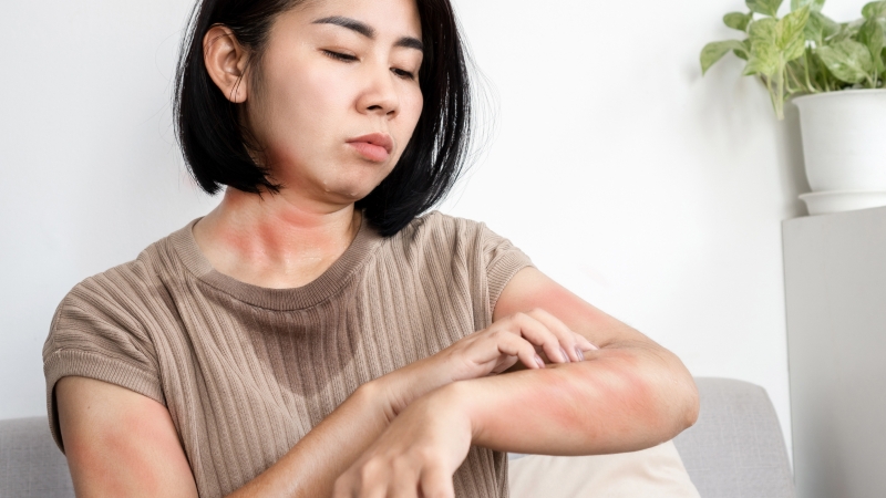 Khi nào cần uống thuốc dị ứng nổi mề đay?