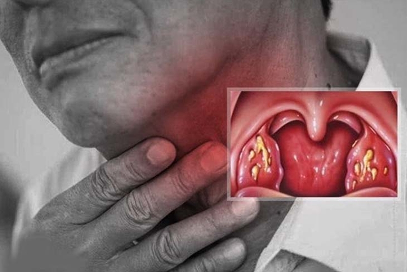 Các loại viêm họng thường gặp và cách phòng ngừa hiệu quả 2