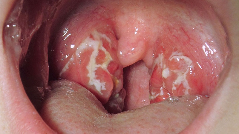 Các loại viêm họng thường gặp và cách phòng ngừa hiệu quả 3