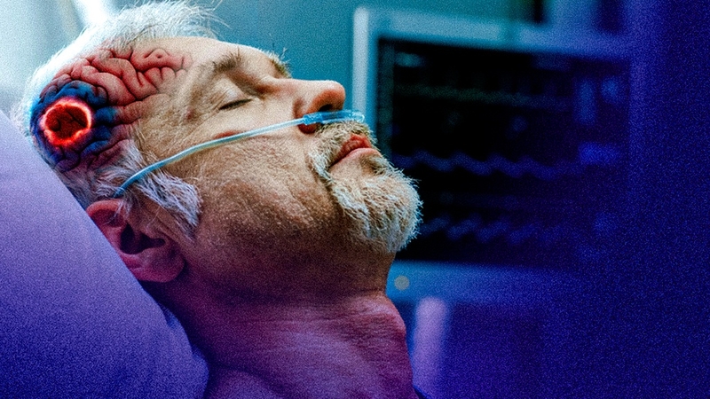 Các loại xuất huyết não: Phân loại cụ thể và cách chẩn đoán 1