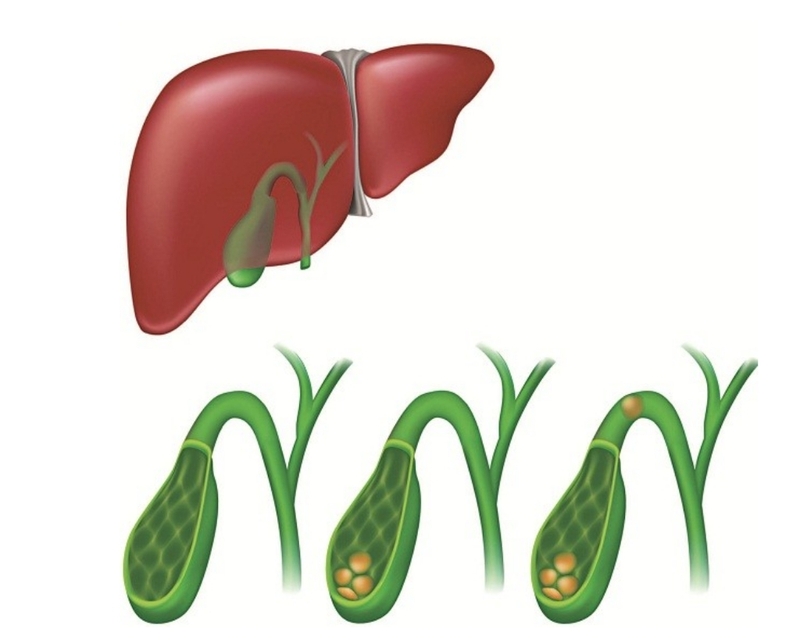 Các mức độ viêm túi mật cấp tính và biện pháp chẩn đoán bệnh 1