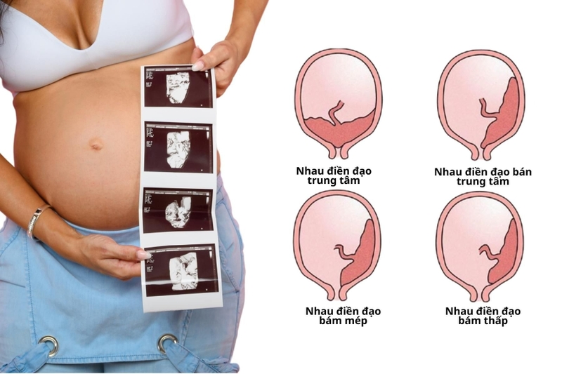 Các nguyên nhân mang thai 20 tuần bị ra máu và cách xử trí 1