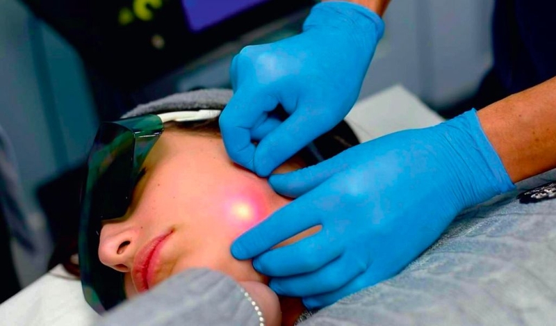 Các phương pháp căng da mặt không phẫu thuật phổ biến hiện nay 3