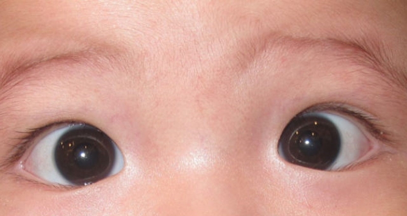 Các phương pháp chữa mắt lác 1