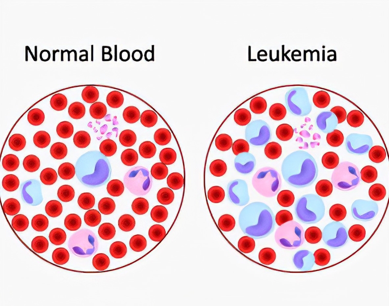Các phương pháp điều trị bệnh bạch cầu dòng tủy mạn tính1