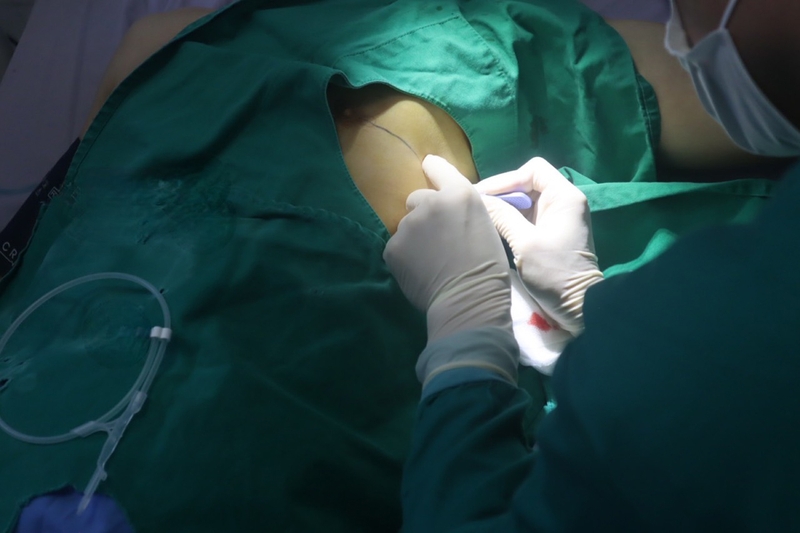 Các phương pháp điều trị nang giả tụy phổ biến hiện nay 3