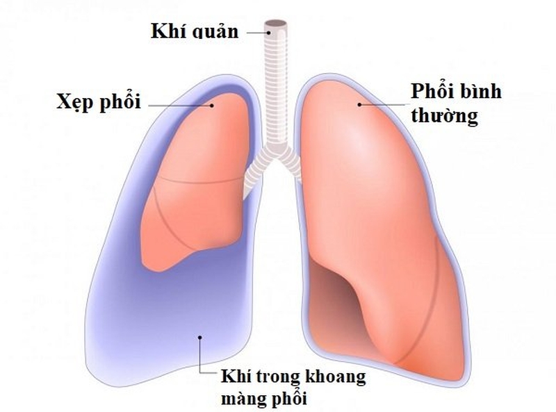 Các phương pháp điều trị tràn khí màng phổi hiện nay 2