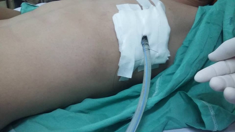 Các phương pháp điều trị tràn khí màng phổi hiện nay 3