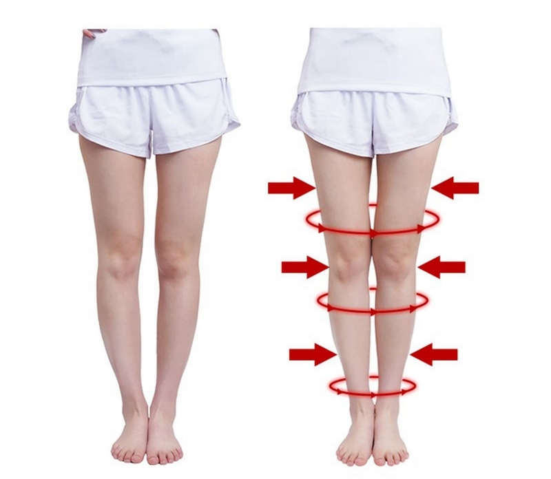 Phương pháp nắn chân vòng kiềng: phẫu thuật nắn chỉnh