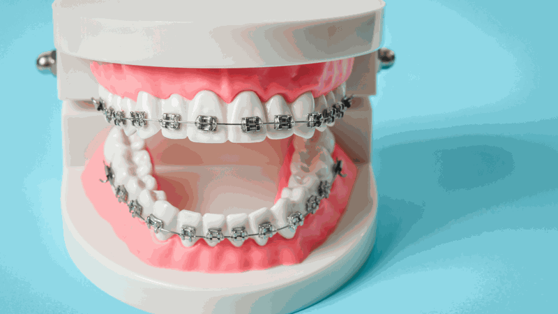 Các phương pháp niềng răng thẩm mỹ hiện nay 1