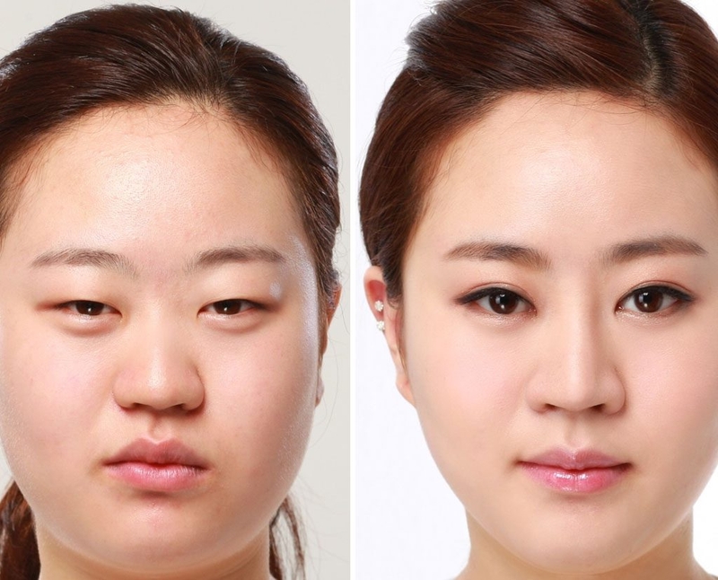 Các phương pháp phẫu thuật sụp mí mắt 2