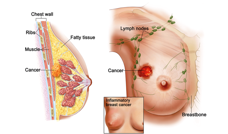 Khối u ung thư vú
