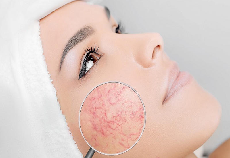 Các phương pháp phục hồi da giãn mao mạch 2