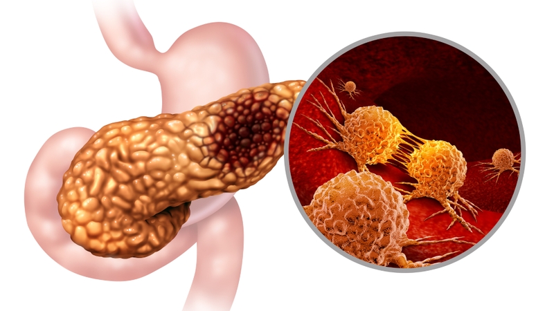 Các phương pháp tiến triển trong điều trị cho bệnh u thần kinh nội tiết tuyến tụy (PNET) 1