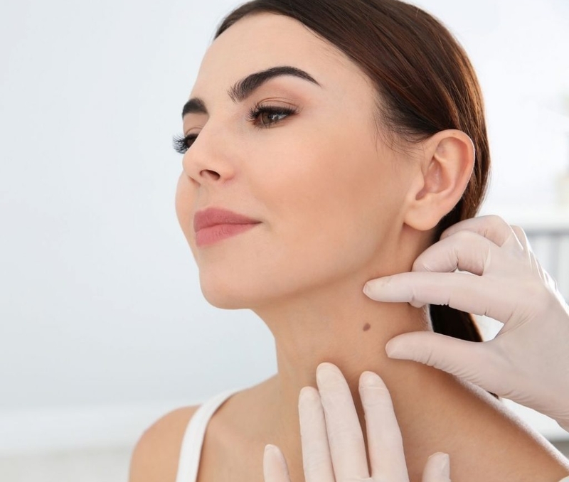 Các phương pháp xóa nốt ruồi 1