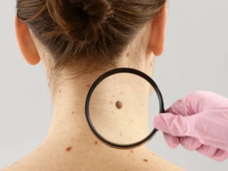 Các phương pháp xóa nốt ruồi 2