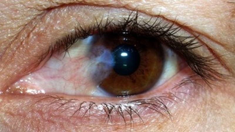 Các triệu chứng của rách võng mạc là gì? 1