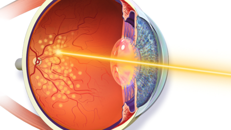 Các triệu chứng của rách võng mạc là gì? 2