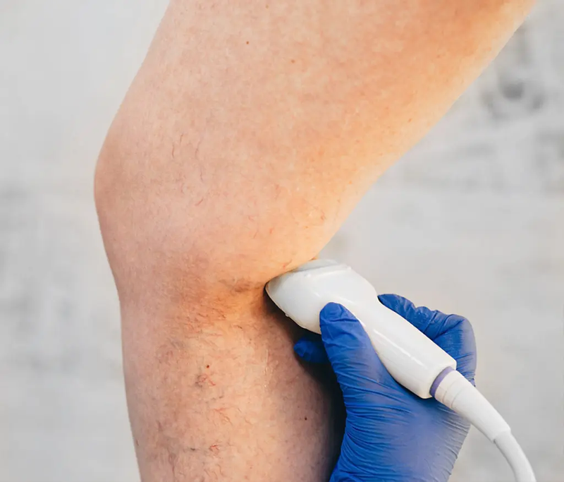 Các triệu chứng giãn tĩnh mạch không nên bỏ qua 5