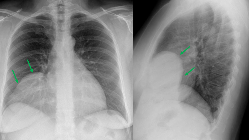 Các triệu chứng khi bị nang màng ngoài tim là gì? 1