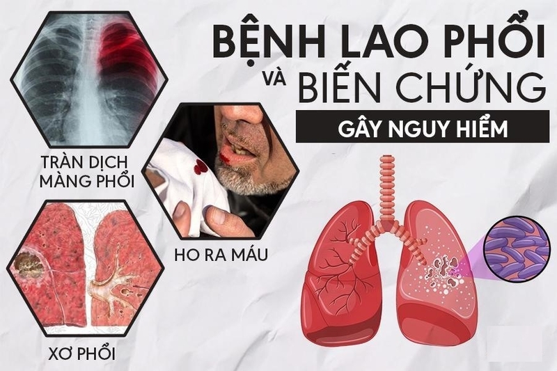 Các triệu chứng khi mắc lao phổi là gì và bệnh lao phổi có nguy hiểm không?