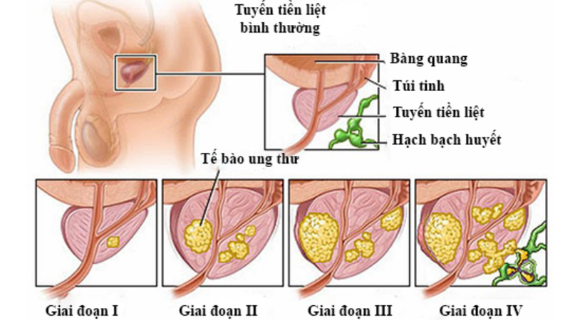 Các triệu chứng ung thư tuyến tiền liệt giai đoạn cuối hay gặp nhất 1
