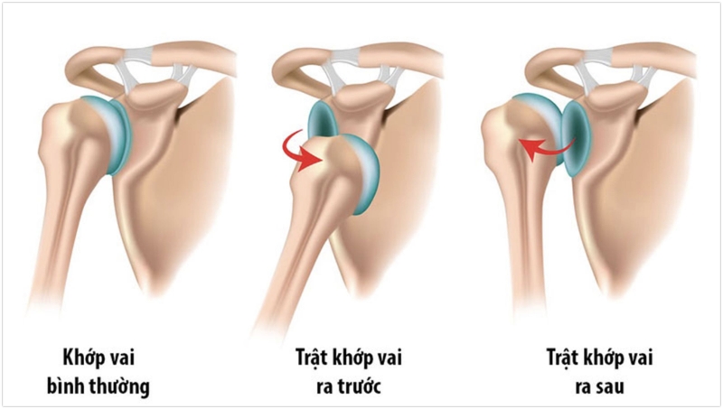 Giải đáp: Các triệu chứng và biến chứng của trật khớp vai 1