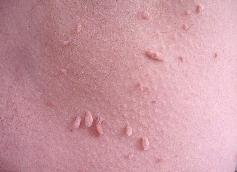 Các triệu chứng và dấu hiệu của bệnh sùi mào gà ở nữ 2