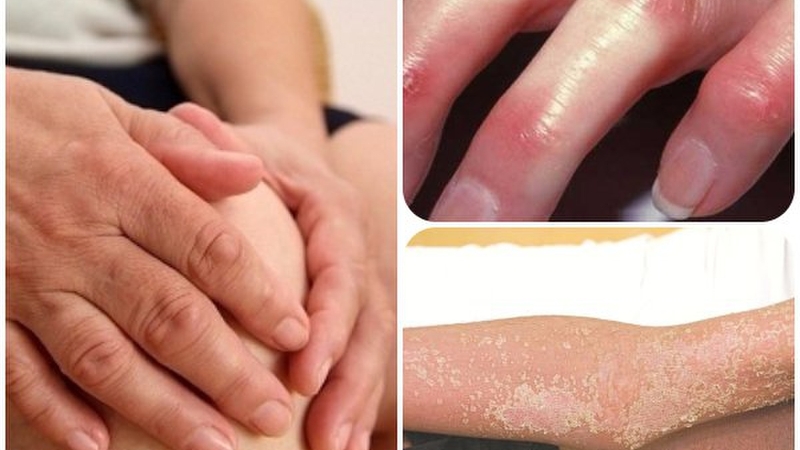 tim-hieu-ve-benh-lupus-ban-do-he-thong-xo-cung-bi-2