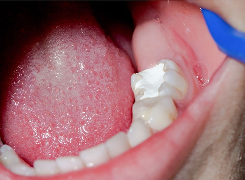 Các trường hợp răng trám bị đau khi nhai và nguyên nhân 1