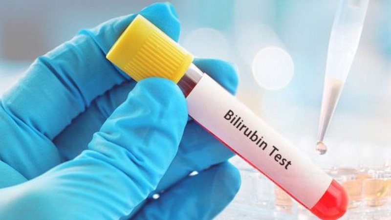 Các xét nghiệm gan ứ mật bạn cần biết 3