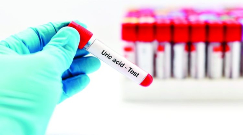 Các xét nghiệm gout cần làm khi có các biểu hiện bệnh