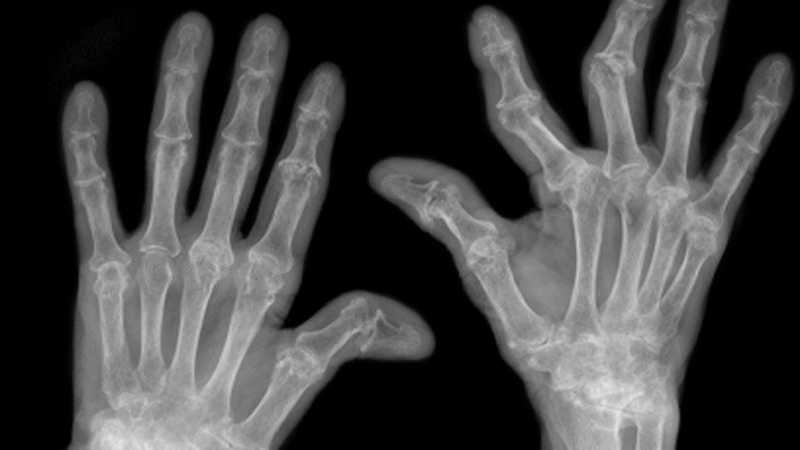 Các xét nghiệm gout cần làm khi có các biểu hiện bệnh